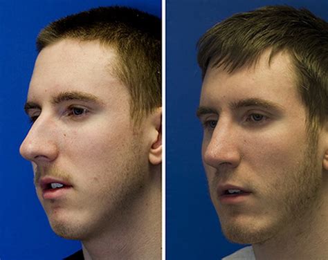 What Does A Bulbous Nose Look Like at Amanda Snyder blog