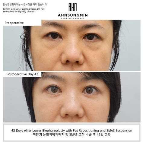 Why Preserving the Aegyo-Sal Matters in Lower Blepharoplasty