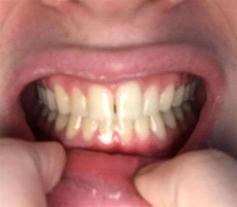 Update: my tooth gap continues to widen and is now very much evident