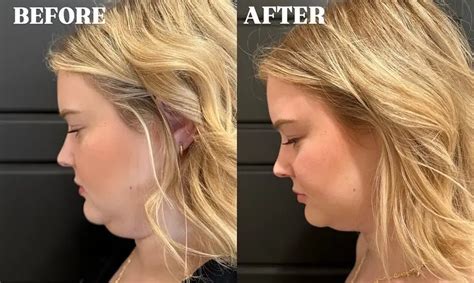 Kybella Before and After - Before After Journey