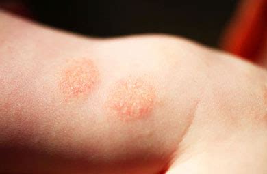 dermatitis definition  dermatitis