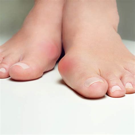 How Do Bunions Begin at Harold Barker blog