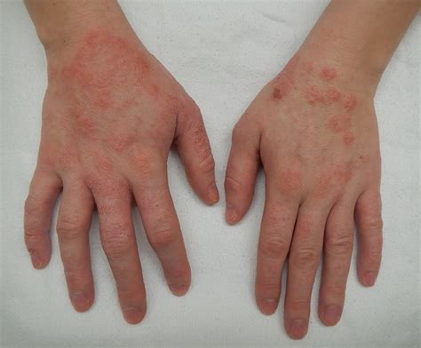 dermatitis eczema nguyen nhan trieu chung va phuong phap dieu tri