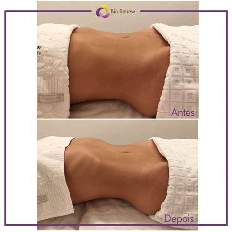 Antes E Depois Da Drenagem Linfatica - Drenagem Linfática Antes E Depois - NAZAEDU