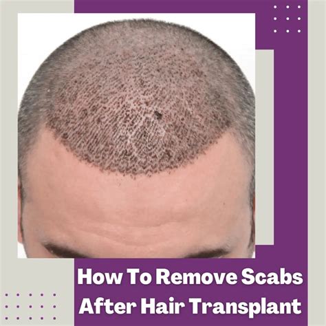 Experts Ideas to Remove Scabs After Hair Transplant