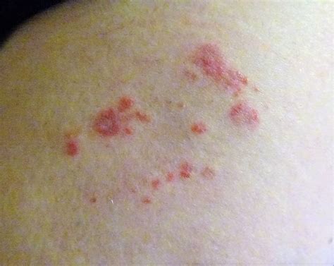 fileshingles rash thigh caused   herpes zoster virusjpg