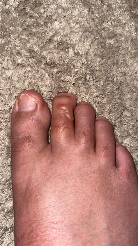 Stubbed my toe yesterday. This is hour 4 up to hour 24. : r/HadToHurt