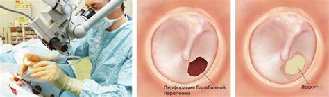 Пробита перепонка в ухе что делать