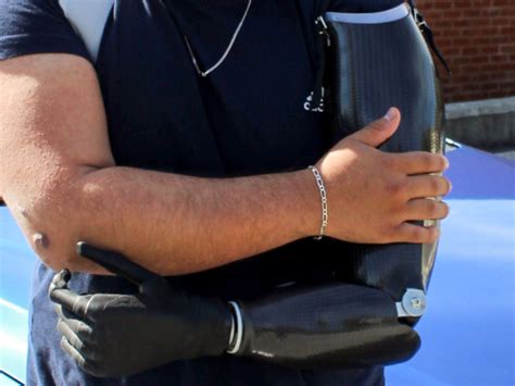 Upper Extremity Prosthetic Options – Shamrock Prosthetics