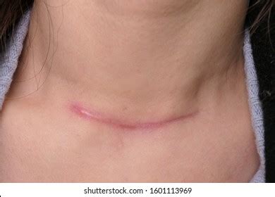 1,839 Neck Scar Images, Stock Photos & Vectors | Shutterstock