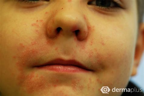 Pickel Um Den Mund Beim Kind: Ursachen & Behandlung | Hebamme FZ