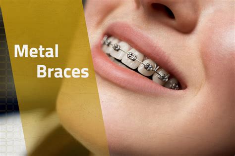 difference  metal braces clear aligners  dubai brightway
