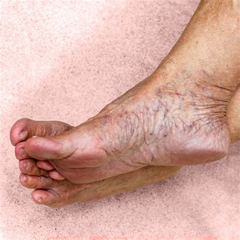 Varicose Veins In Feet Can Varicose Veins Cause Skin Discoloration?: