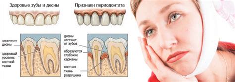 Периодонтит: откуда берется и как вылечить | Healthy Dent (Киев)