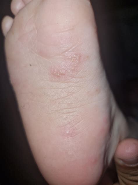 Is this scabies ? Just on my sons feet? : r/scabies