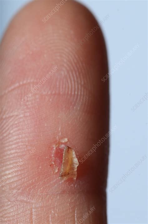 scab stock image  science photo library