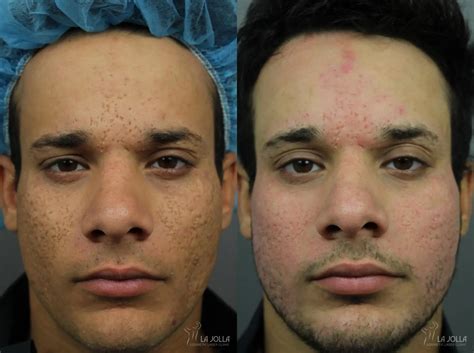 acne scars   gallery patient