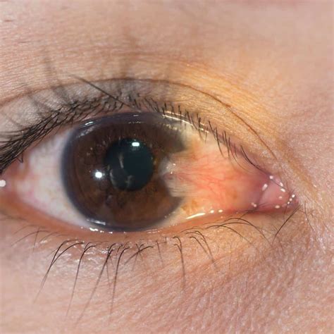 red eyes kidney problems  jaclyn glenn blog