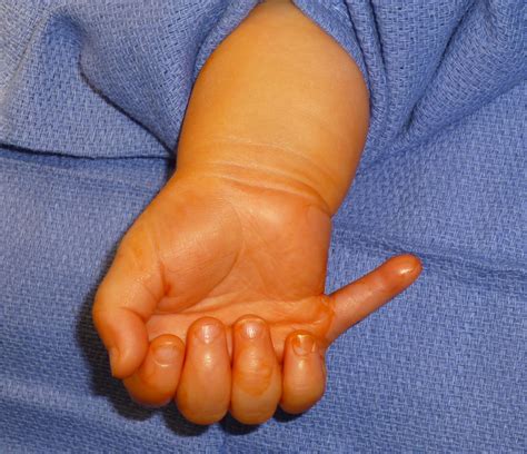 extra digits congenital hand  arm differences washington