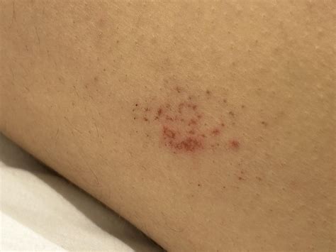 Inner thigh rash, itches. What is it? : r/DermatologyQuestions