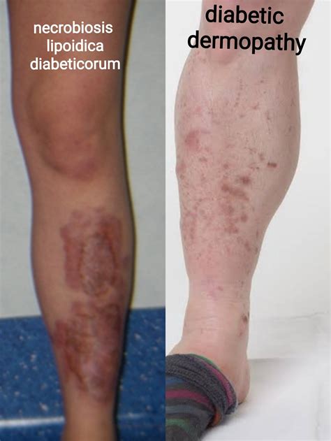 Necrobiosis Lipoidica Diabeticorum