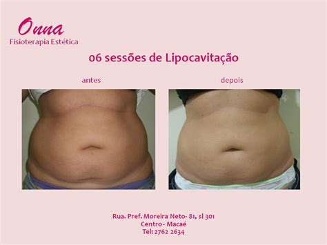 Lipocavitação O Que É E Como Funciona