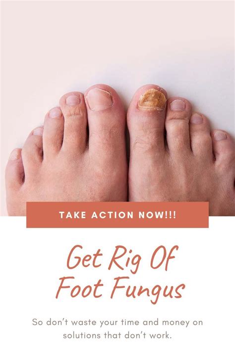 Get rid of foot fungal infection – Artofit