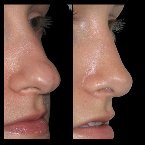 Cleft Nose Tip