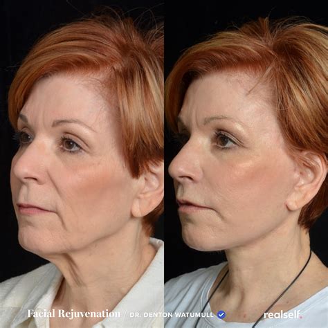 facelift recovery tips   facelift recovery face lift