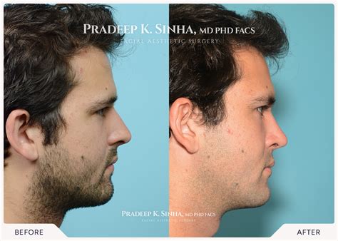 male rhinoplasty atlanta nose surgery  men  georgia