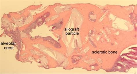 Understanding Sclerotic Bone | SteinerBio™