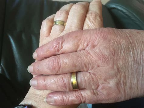 Battling blog | Battling Bowel Cancer