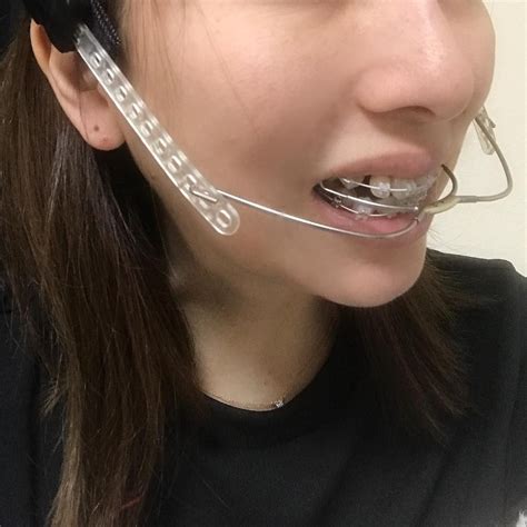 reikoxoxo instagram profile orthodontics headgear