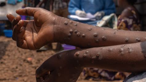 mpox spread      risk   york times