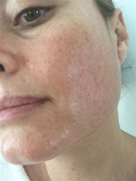 Sensitive Skin S.O.S – The Products I Turn To When My Skin Flares Up