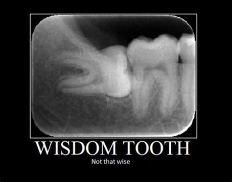 25 Wisdom Teeth Memes That Are Too Funny For Words - SayingImages.com