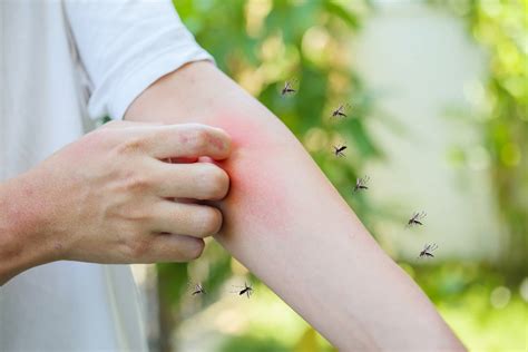 Mosquito bites
