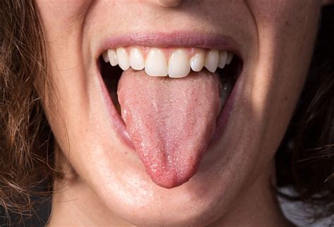Tongue Hurts After Eating Vinegar at Emma Rouse blog