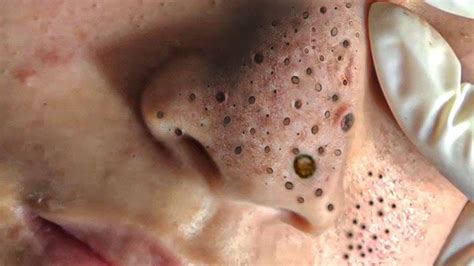 Unbelievable Blackhead Removal 2024: The Step-by-Step Guide to Clear, Glowing Skin - wpvd106