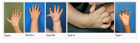 Thumb Hypoplasia | Bone and Spine