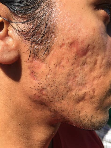 acne  types diagnosis treatment prognosis