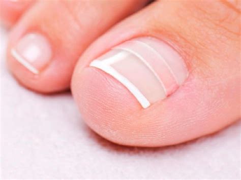 how to fix a curved toenail