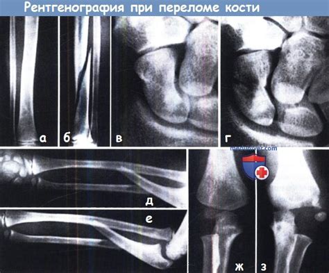 Признаки и диагностика перелома кости