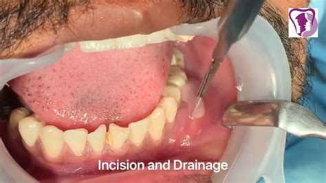 periodontal abscess drainage  frank royalty blog