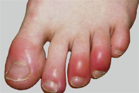 chilblains medical term  howard franklin blog