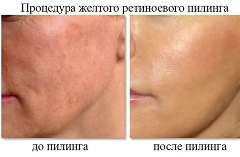 Желтый пилинг для лица: отзывы, фото-результаты до и после применения