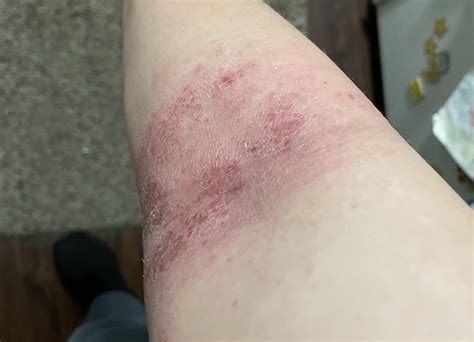 Allergic Reaction Bandage Rash at Ronald Lerner blog