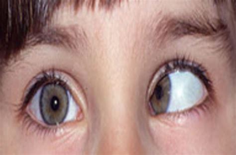 how to fix crossed eyes