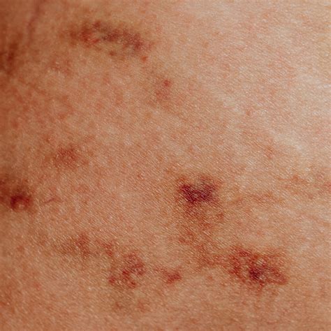 macchie scure sulla pelle cosa fare gosalute