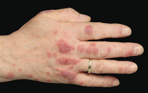 Case of painful rash, a manifestation of leukemia cutis